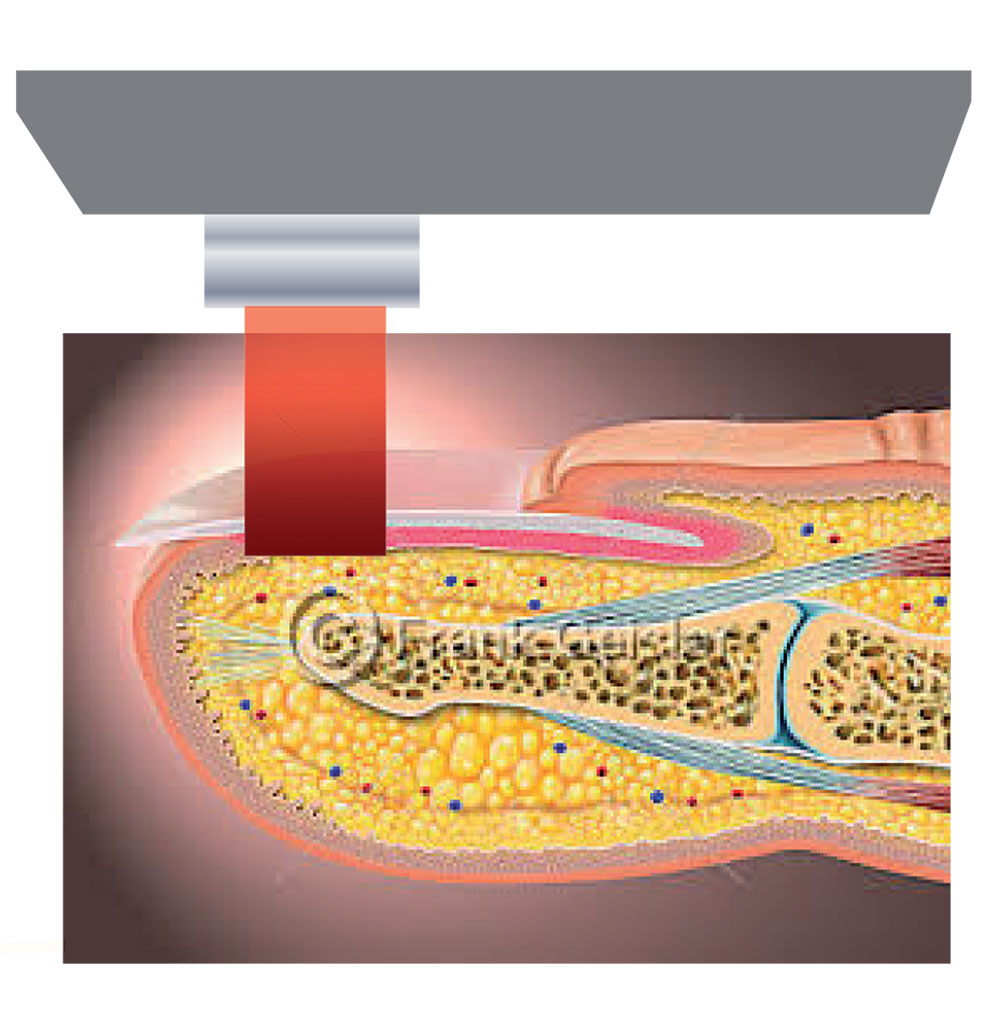 GME - Diode Laser Model LinScan